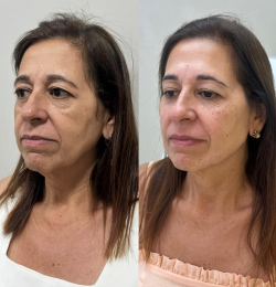 Bioestimuladores de colágeno - Dra. Kamila Lobo