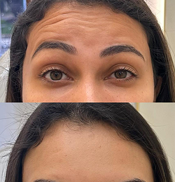 Botox - Dra. Kamila Lobo
