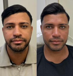 Full Face Masculino - Dra. Kamila Lobo