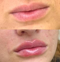 Preenchimento labial - Dra. Kamila Lobo
